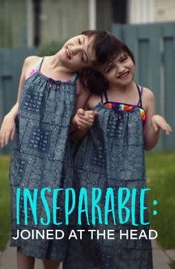 Inseparable: Joined at the Head