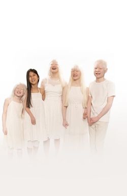 Born with Albinism