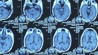 Episode 4 The Alzheimer's Project: Momentum in Science (Part 1)